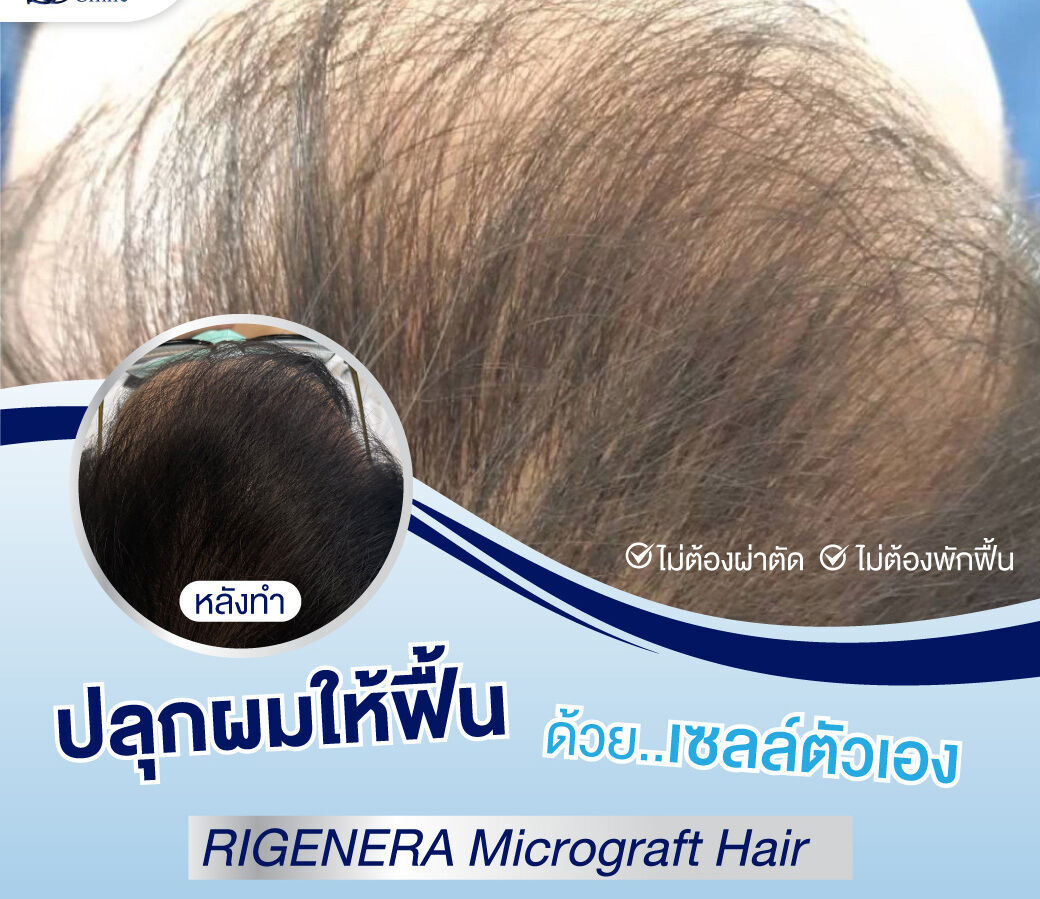 ปลูกผมไมโครกราฟต์ สร้างผมใหม่ด้วยเซลล์รากผมตัวเอง Regenra Micrograft Hair